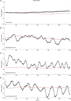 Ocular Tremor in Parkinson’s Disease: Discussion, Debate, and Controversy